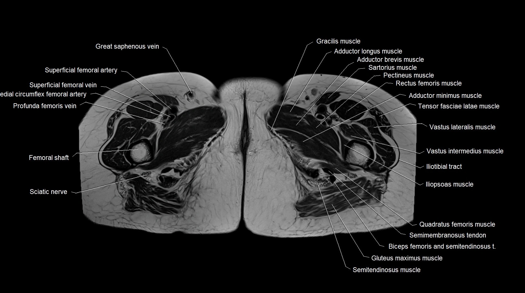 MRI 3T pelvis axial cross section anatomy image 34.webp